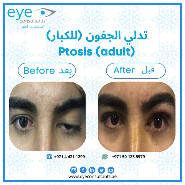 01 Oculoplasty Before and After