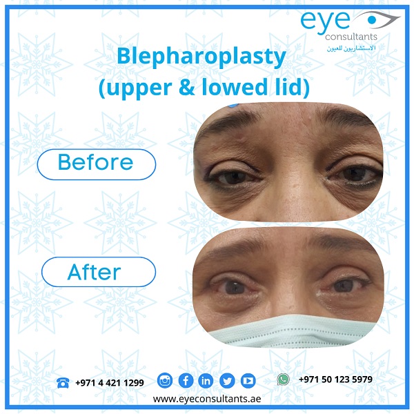 02 Oculoplasty Before and After