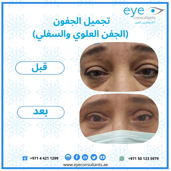 03 Oculoplasty Before and After