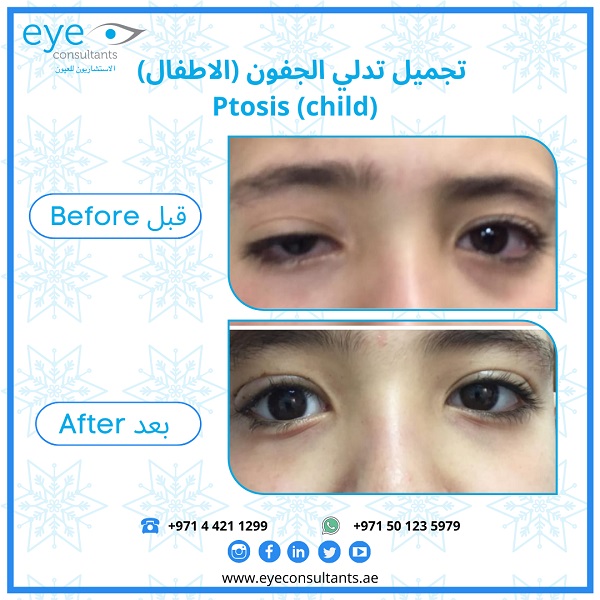 04 Oculoplasty Before and After