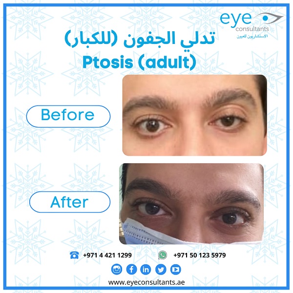 05 Oculoplasty Before and After