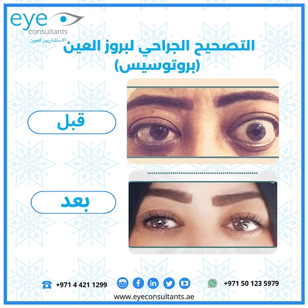07 Oculoplasty Before and After