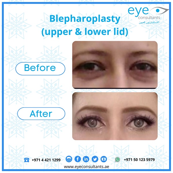 08 Oculoplasty Before and After