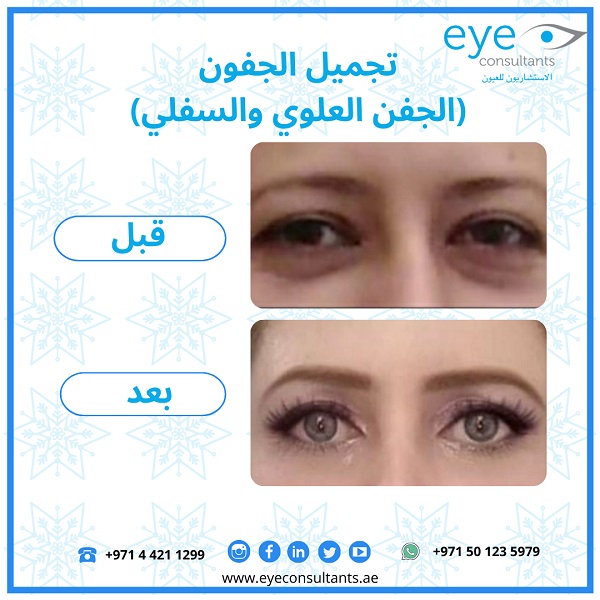 09 Oculoplasty Before and After