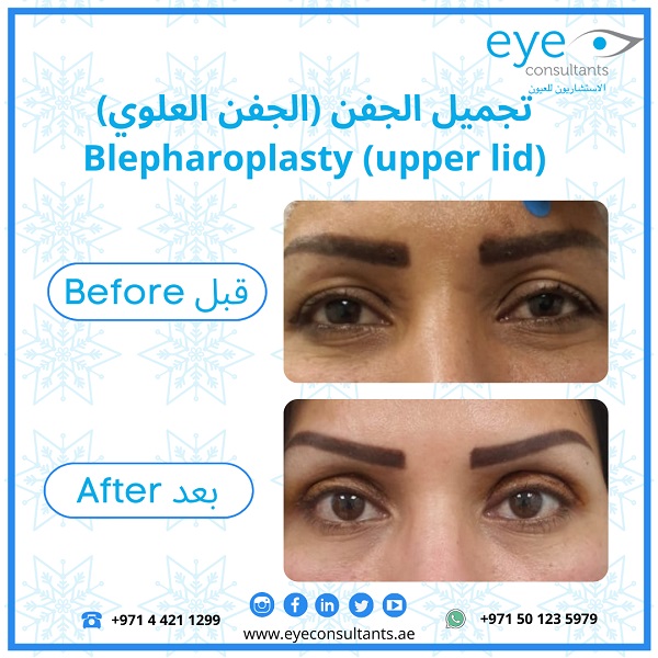 10 Oculoplasty Before and After