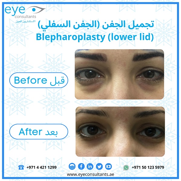 12 Oculoplasty Before and After