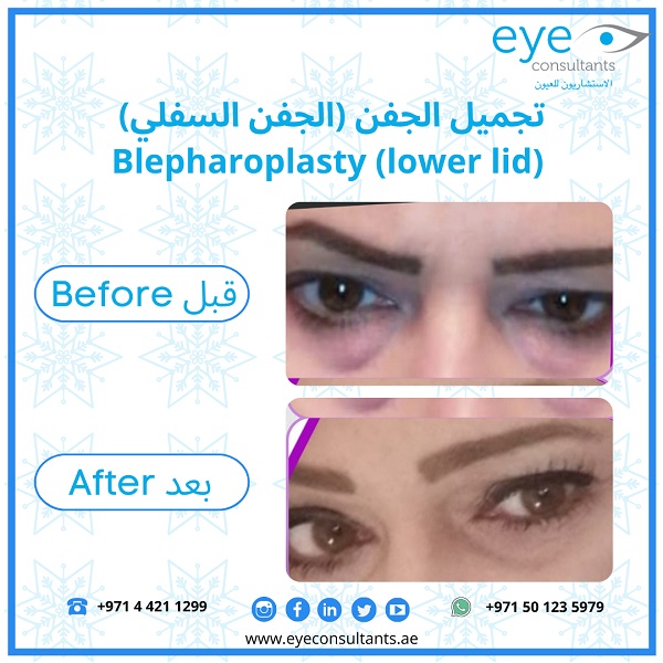 13 Oculoplasty Before and After