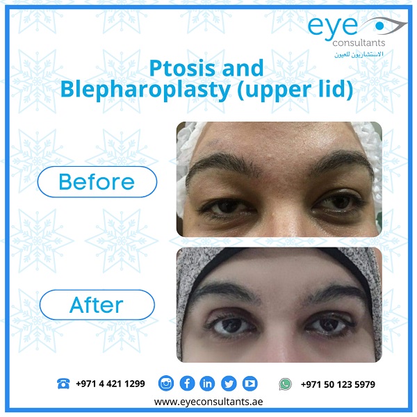 15 Oculoplasty Before and After