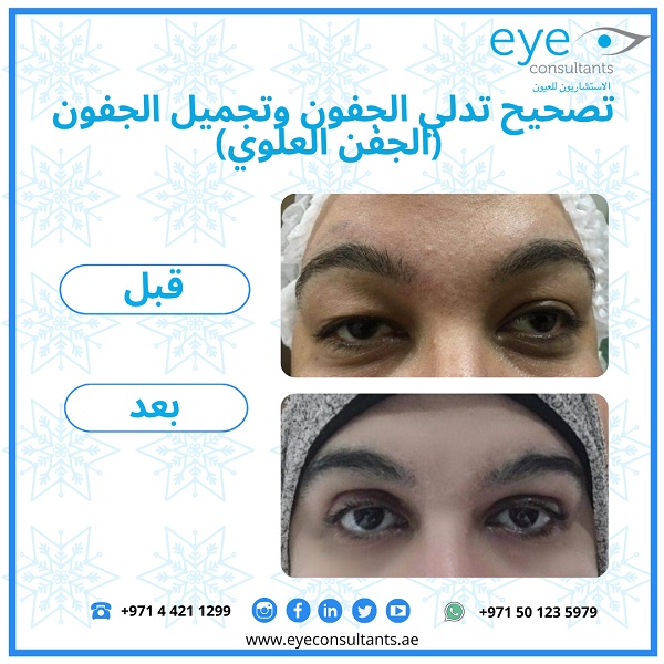 16 Oculoplasty Before and After