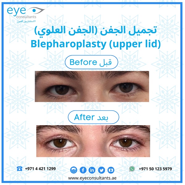 17 Oculoplasty Before and After