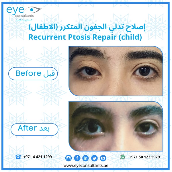 18 Oculoplasty Before and After