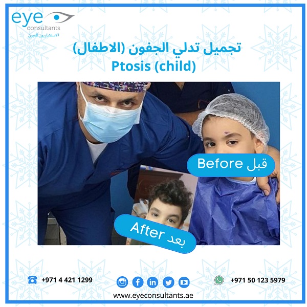 21 Oculoplasty Before and After