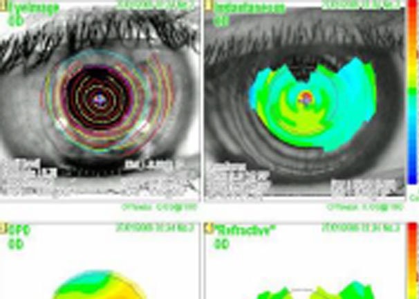 Keratoconus