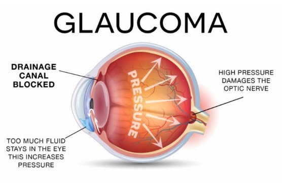 Glaucoma Treatment
