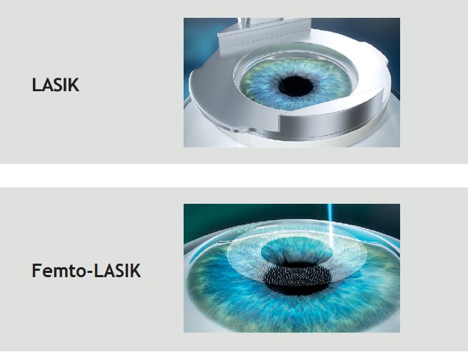 Lasik vs Femtolasik