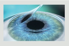 Lasik Procedure