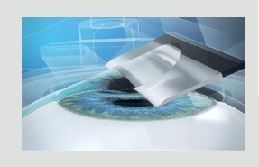 Lasik Blade