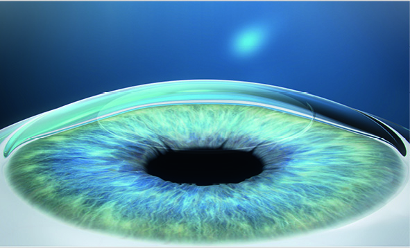 SMILE Patient Brochure EN