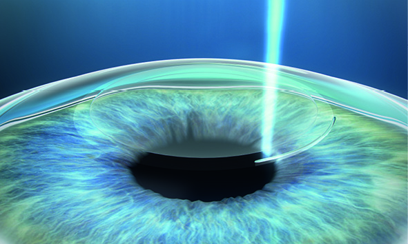 SMILE Patient Brochure EN