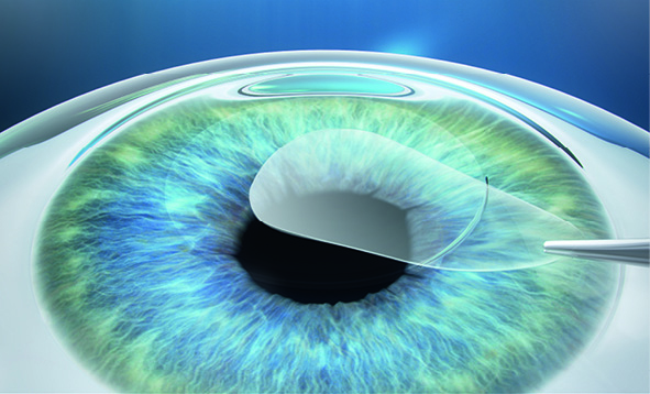 SMILE Patient Brochure EN