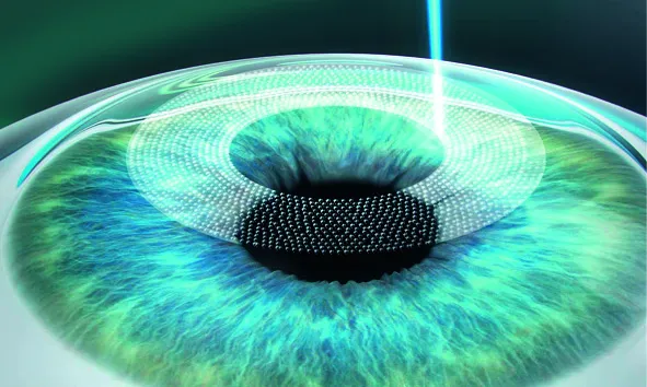 femtolasik-step-1_11zon