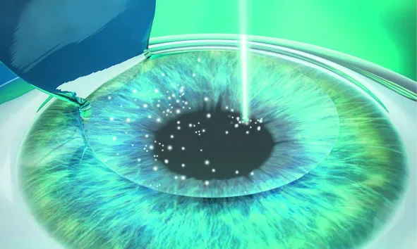 femtolasik-step-4_11zon