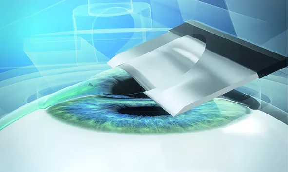 lasik-surgery-step-2_11zon